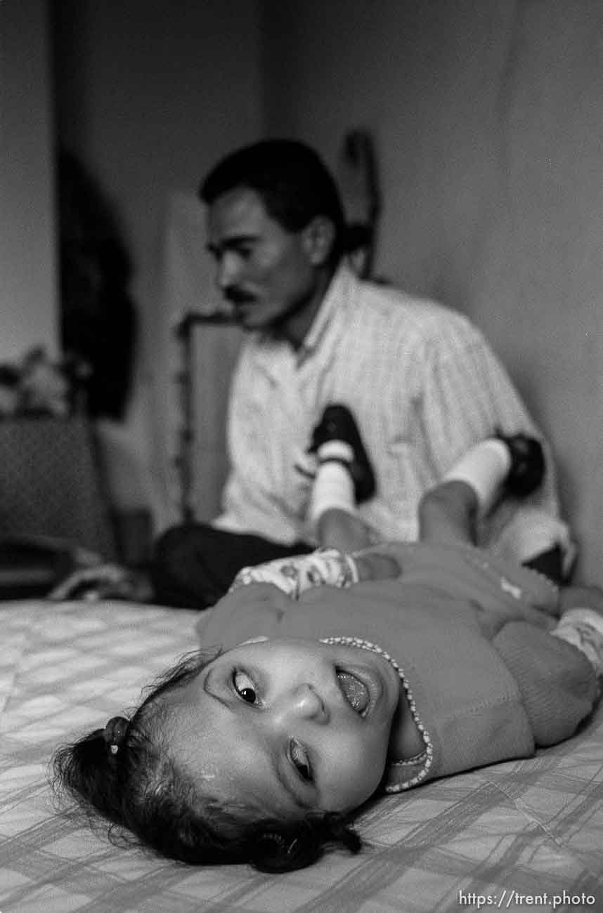 Bessy on bed, Jose in background. Formerly conjoined twins, Bessy and Doris Gonzales.